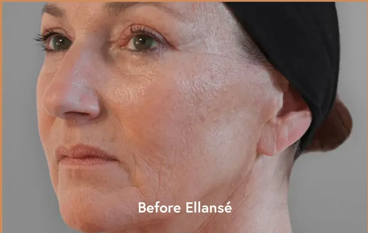 Ellansé cas 1 — avant traitement — Beauvoir Clinic, Waterloo