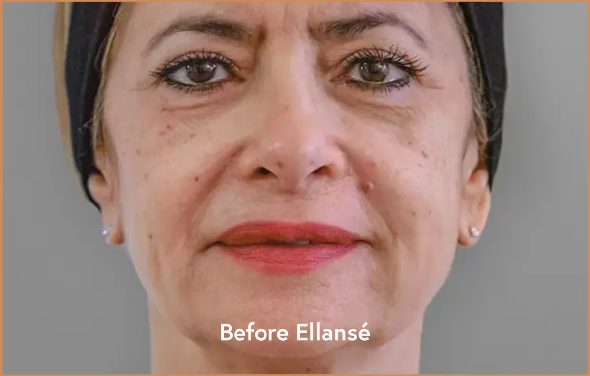 Ellansé cas 2 — avant traitement — Beauvoir Clinic, Waterloo
