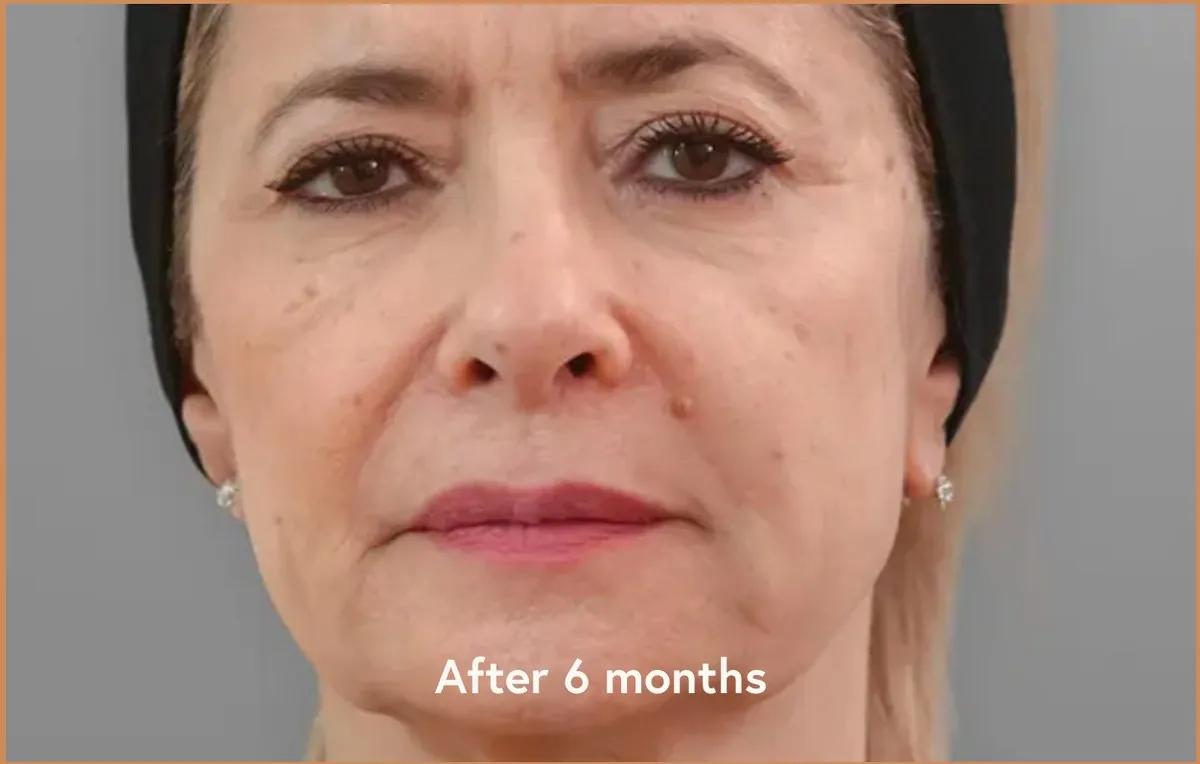 Ellansé cas 2 — J+15 — Beauvoir Clinic, Waterloo