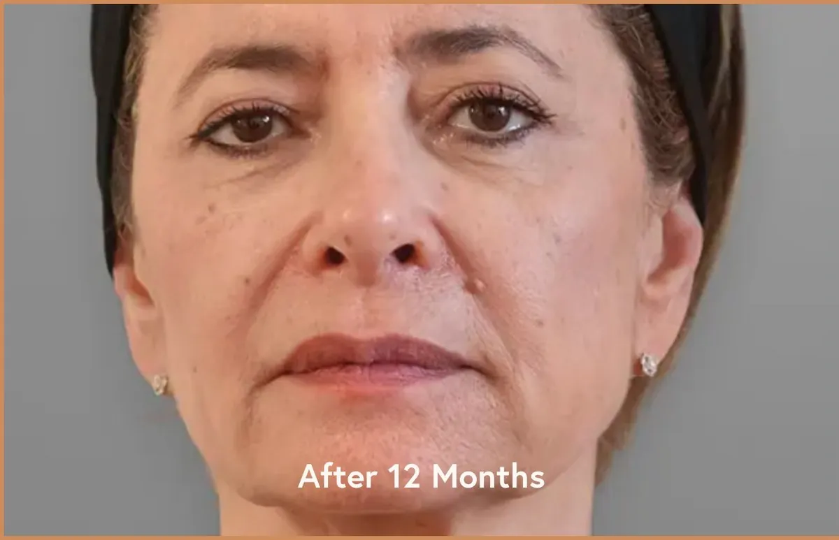 Ellansé cas 2 — 3 mois — Beauvoir Clinic, Waterloo