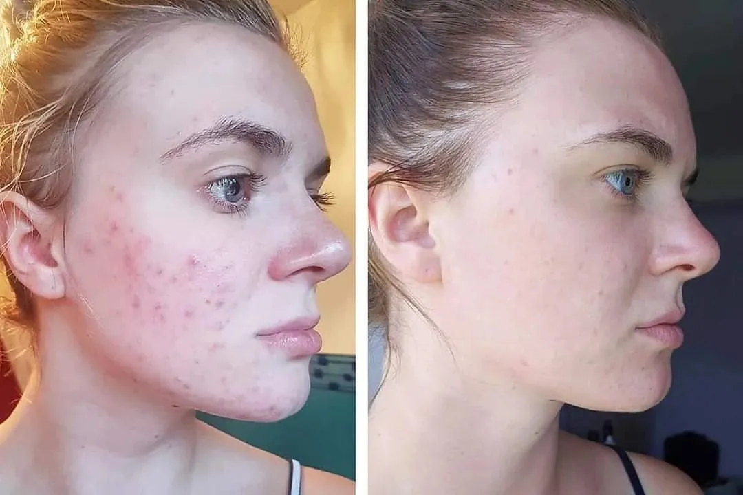 Amélioration de cicatrices d'acné par microneedling — Beauvoir Clinic, Waterloo