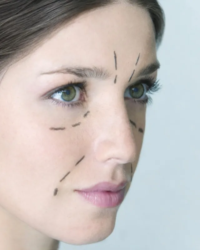 Repères d'injection d'acide hyaluronique tracés sur le visage d'une patiente — Beauvoir Clinic, Waterloo