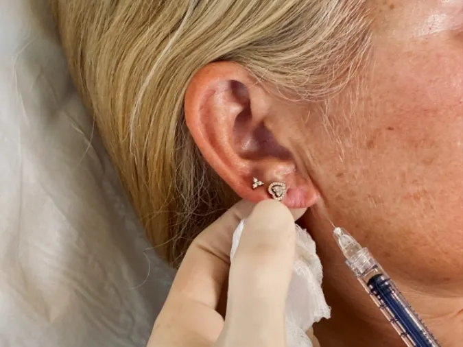 Gros plan d'une injection d'acide hyaluronique le long de la mâchoire — Beauvoir Clinic