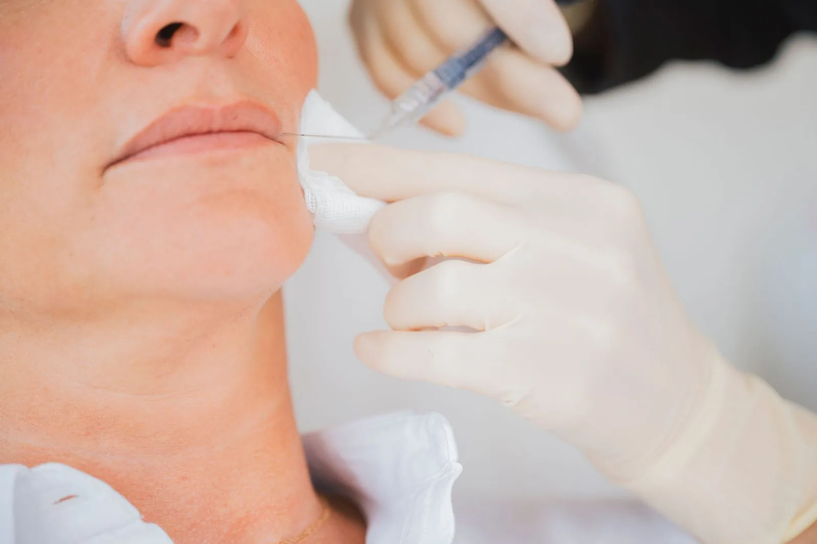 Injection d'acide hyaluronique au contour des lèvres — Beauvoir Clinic, Waterloo