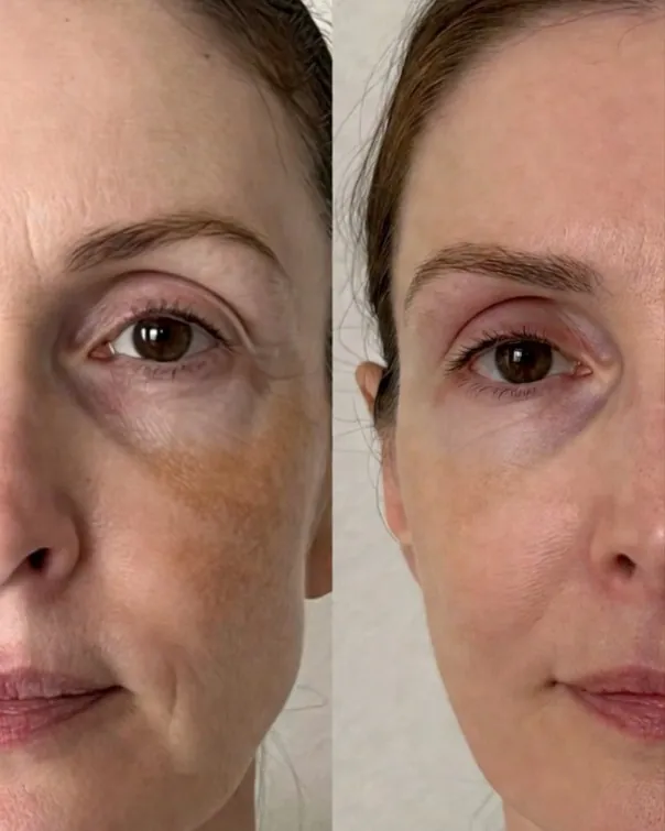 Attiva, radiofréquence endodermale : évolution du contour du visage, vue comparative avant et après