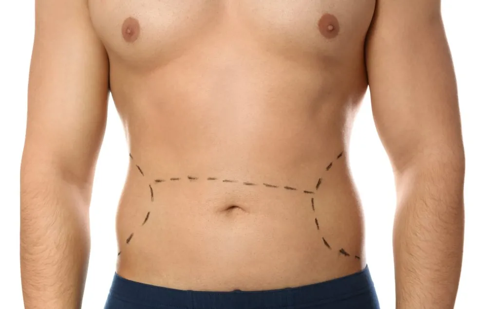 Cryolipolyse chez l'homme : repères tracés sur l'abdomen avant la séance — Beauvoir Clinic