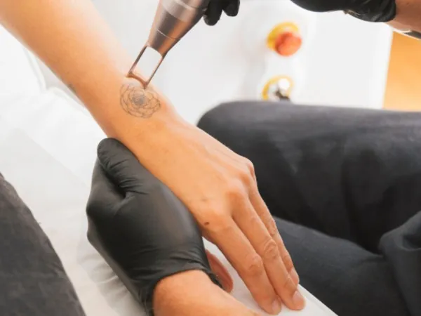 Pièce à main du laser de détatouage positionnée sur un tatouage de l'avant-bras