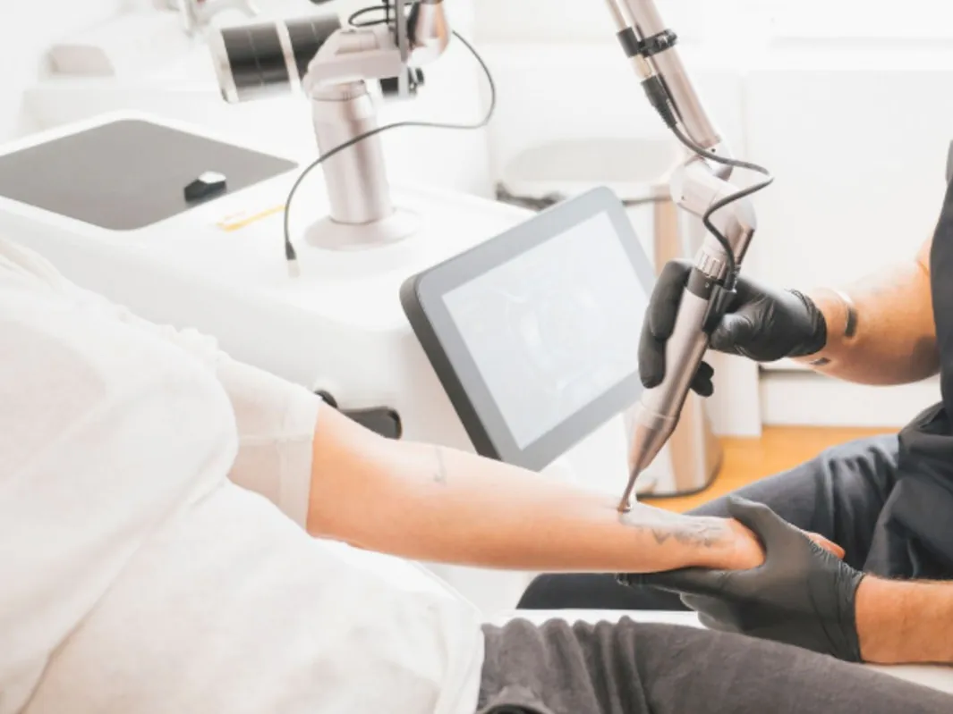 Séance de détatouage laser : l'appareil et son bras articulé en action sur l'avant-bras
