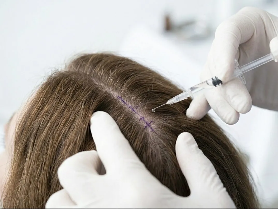 Traitement — Exosomes Cheveux