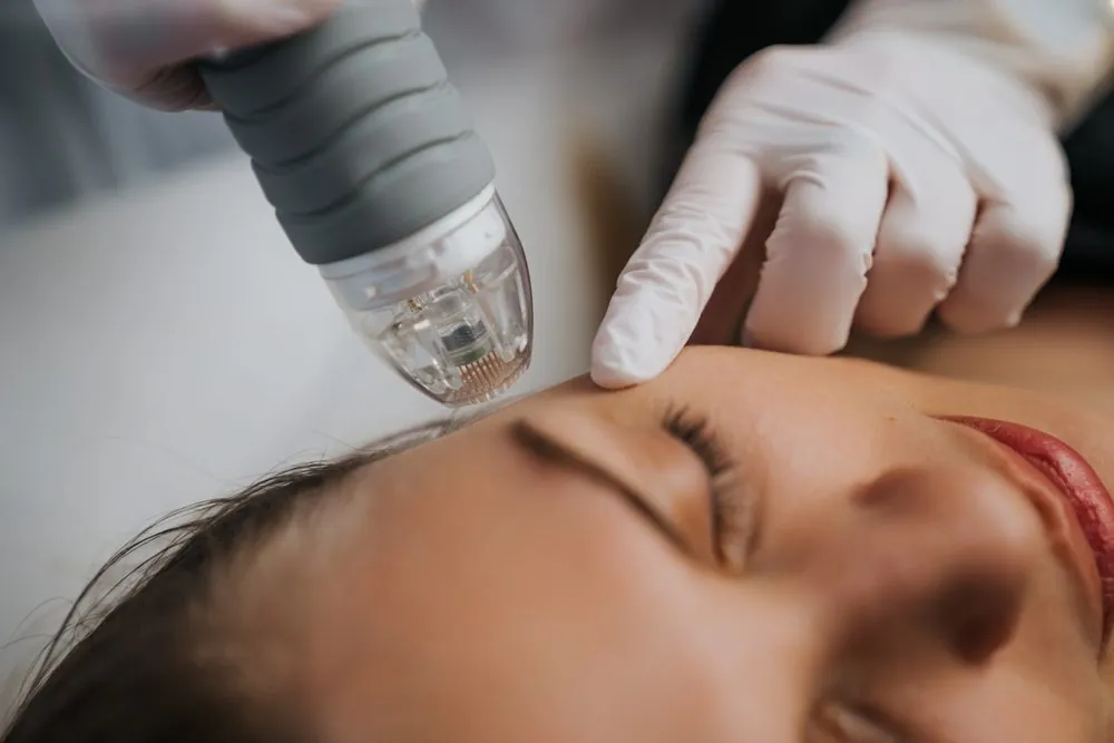 Microneedling à Waterloo — Beauvoir Clinic