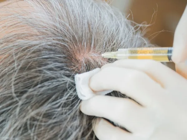 Injection de PRP dans le cuir chevelu, gros plan sur la seringue — Beauvoir Clinic, Waterloo
