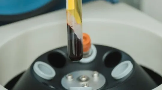 Tube de sang centrifugé pour obtenir le plasma riche en plaquettes (PRP)