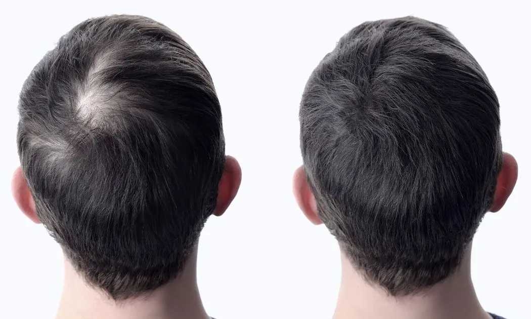 Densité capillaire sur le sommet du crâne : évolution avant et après PRP cheveux