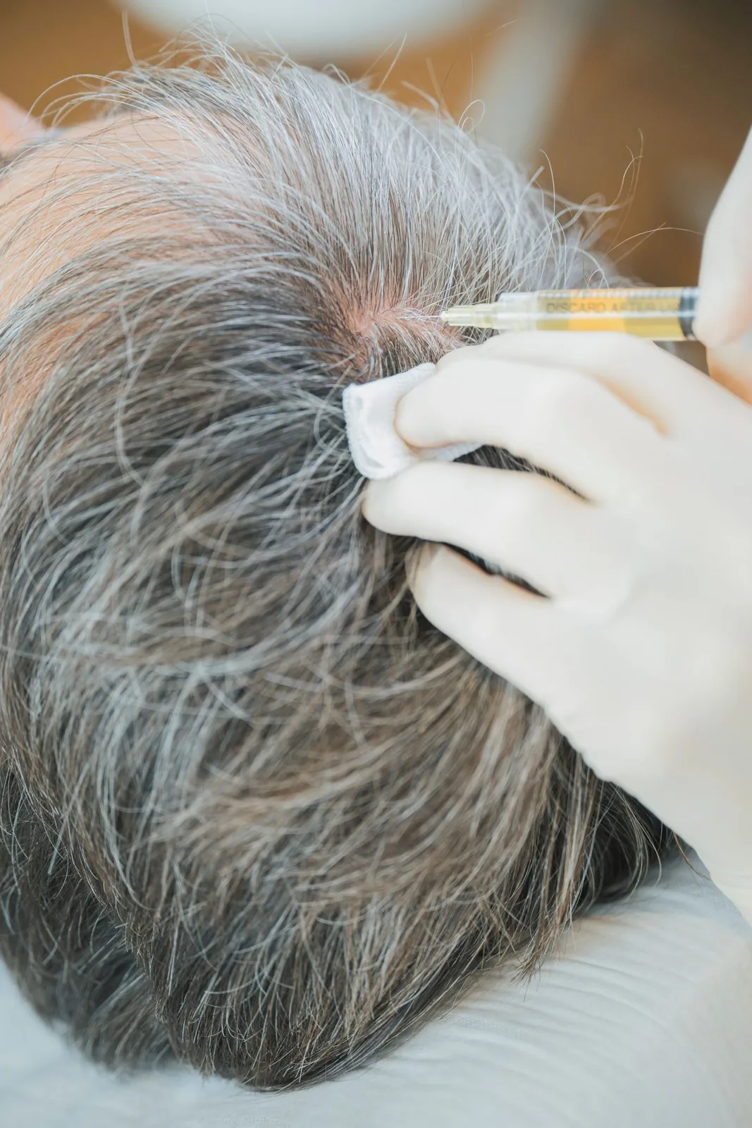 Séance de PRP cheveux : injections sur la zone clairsemée du cuir chevelu — Waterloo