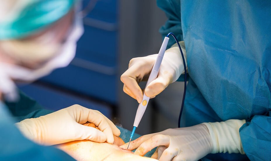 déroulement de l'opération d'augmentation mammaire