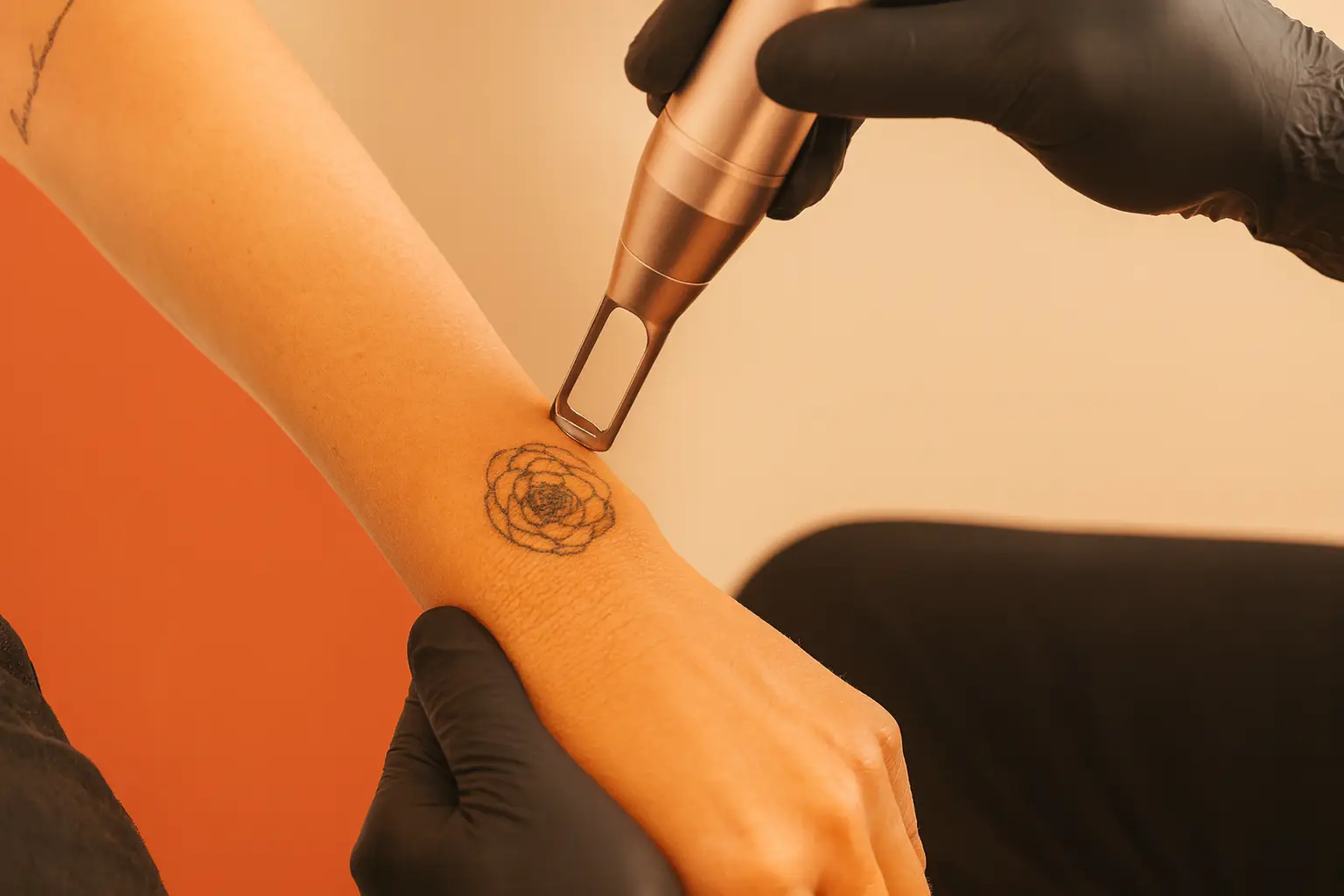 Suppression de tatouage au laser sur le bras