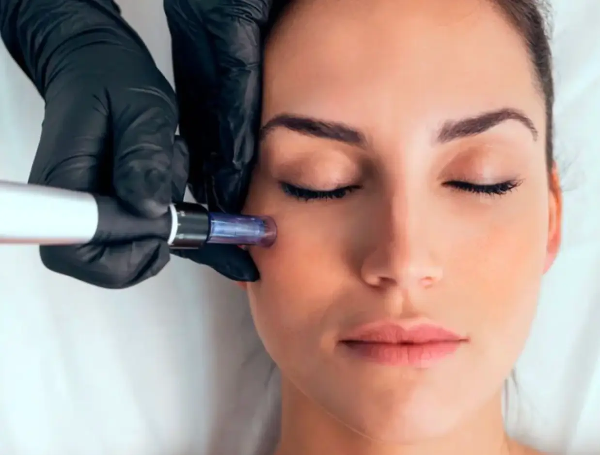 Traitement du visage par microneedling en institut