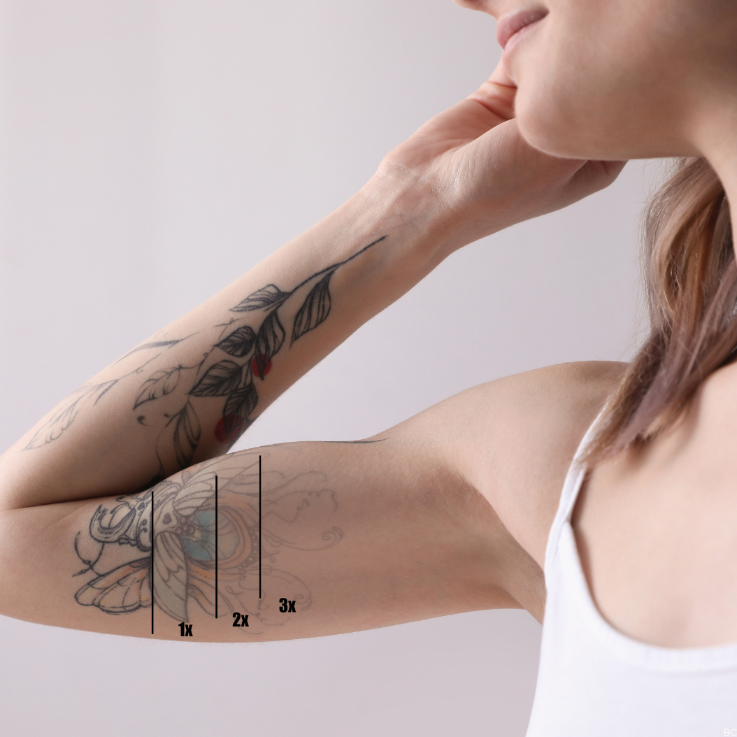 évolution du détatouage  au picolaser chez beauvoir Clinic